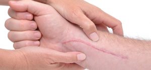 Litteken littekenmassage littekentherapie littekenbehandeling huidtherapie Huidtotaal Arnhem