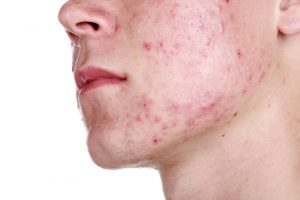 Acne gezicht