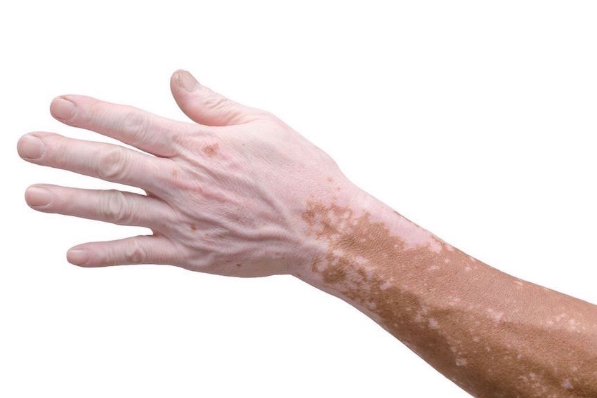 Vitiligo camouflagetherapie