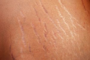 striae huidstriemen huidtherapie