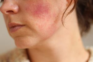 Rosacea behandeling huidtherapeut Arnhem